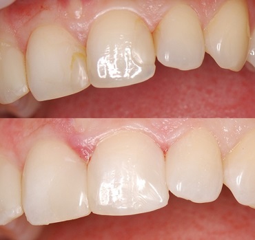 Особливості реставрації передніх зубів