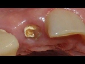 Чому виникає білий наліт на лунці видаленого зуба