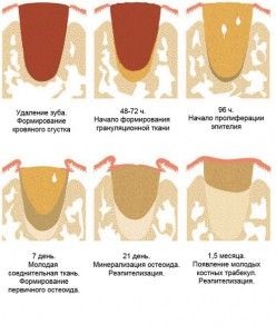 Чому виникає білий наліт на лунці видаленого зуба