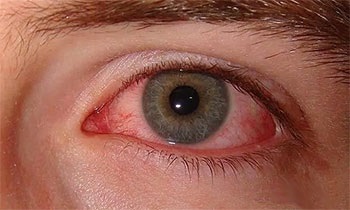Сильно болять очі і голова що робити, якщо тисне на органи зору