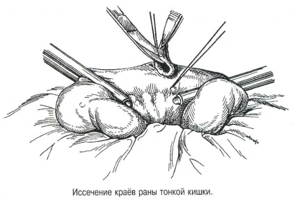 Allsurgery - пошкодження тонкої кишки 1