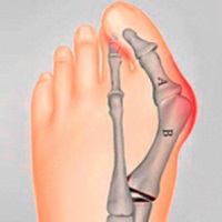 Біль у стопі (ступні) при настанні посередині, збоку (з зовнішньої, внутрішньої сторони) лікування