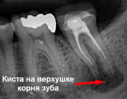 Кіста зуба симптоми, наслідки і все, що ви хочете знати