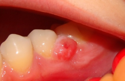 Кіста зуба симптоми, наслідки і все, що ви хочете знати