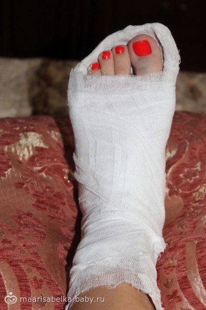 Перелом великого пальця ноги
