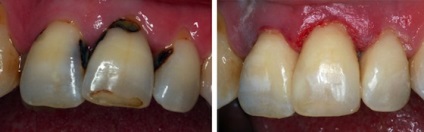 Пришийковий карієс - причини, симптоми, лікування карієсу шийки зуба - стоматологічний портал