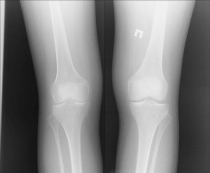 Radiografie la picior