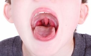 Симптоми і причини ангіни у дітей особливості перебігу різних форм