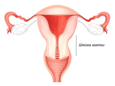 Міома шийки матки симптоми, лікування (видалення), вплив на вагітність