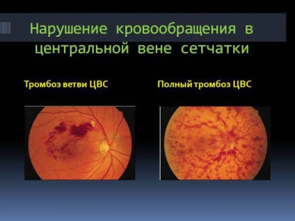 Тромбоз центральної вени сітківки ока лікування і симптоми