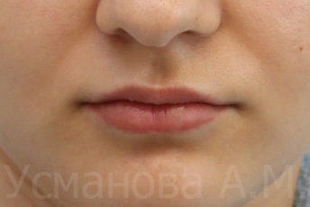 Збільшення обсягу губ, збільшити губи гіалуроновою кислотою