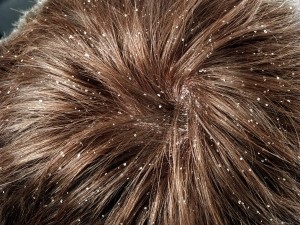 Сверблячка шкіри голови причини і лікування народними засобами