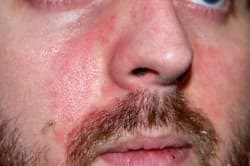 Червоні плями на обличчі після алкоголю причини, лікування
