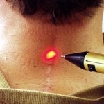 Видалення шрамів і рубців лазером - переваги і недоліки