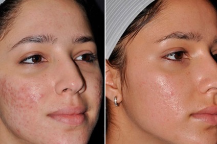 Видалення шрамів і рубців на шкірі обличчя лазерне лікування, корекція пілінгом і аптечними препаратами