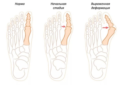 Кісточка на великому пальці ноги лікування