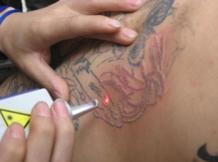 Видалення татуїровок лазером