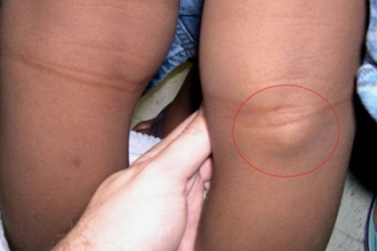 Лікування кісти Бейкера колінного суглоба народними засобами