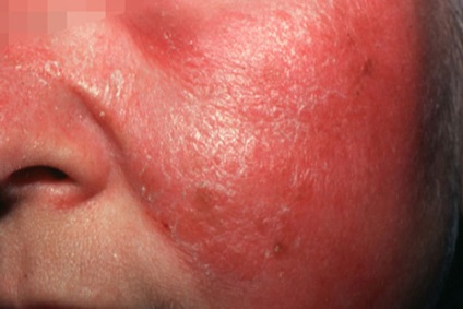 З'явився пухир на шкірі від чого, що буде, якщо почухати, причини та види захворювань
