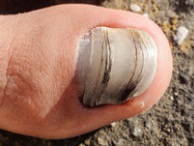 Уколи краси, профілактика грибка нігтів на ногах