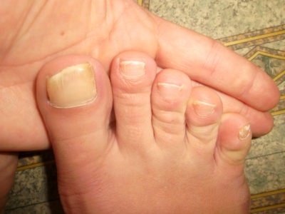 Жовті нігті на ногах причини і лікування, чому жовтіють