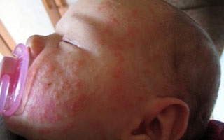 Алергічний дерматит у немовлят - симптоми і лікування (фото)