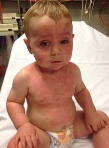 Алергія на козяче молоко у дитини симптоми