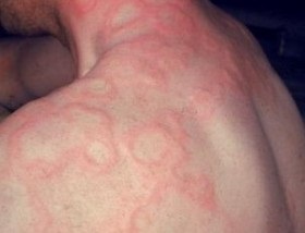 Алергія на тепло