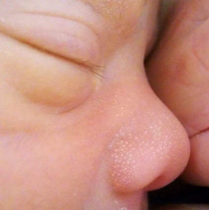 Яка буває висип на обличчі у новонародженого