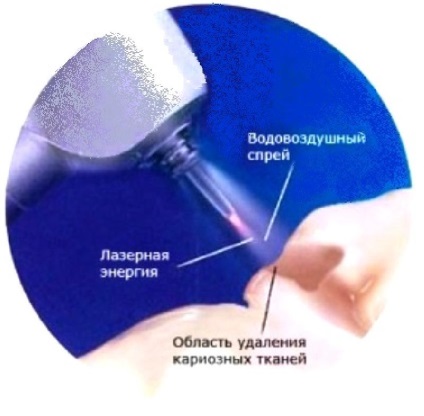 Лікування карієсу лазером в Воронежі ціни, відгуки та адреси клінік