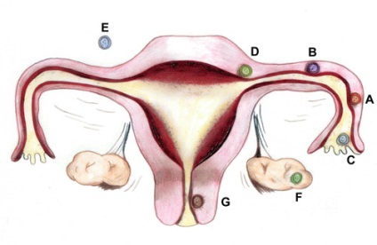 Ознаки позаматкової вагітності