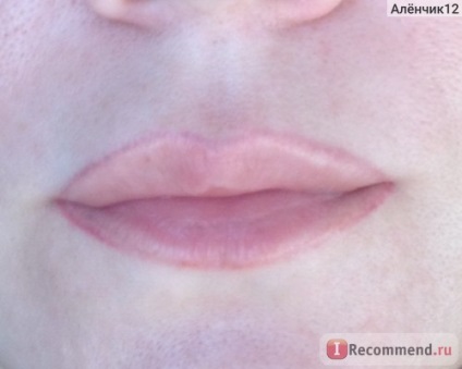Збільшення губ за допомогою биополимера (біогель) - «біополімерний гель подарував мені верхню губу