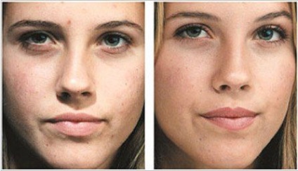Вакуумна чистка шкіри обличчя - що це плюси і мінуси
