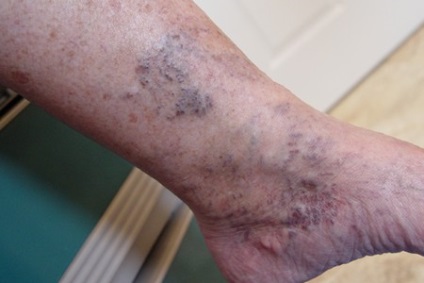 Varice pe picioare - diagnostic, tratament și prevenire + 69 de fotografii - Hips - 