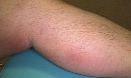 puncte negre pe picioare în varicoza
