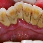 Чи можна лікувати і видаляти зуби під час місячних