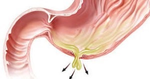 Перфоративная виразка шлунка - сучасні підходи до оперативного лікування, хірурги ро
