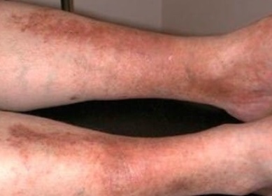 pete întunecate pe picior în varicoza
