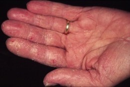 Екзема на руках - симптоми, методи лікування, фото екземи