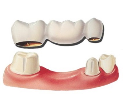 Мостовидні зубні протези