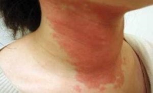 Алергія на шиї у дітей і дорослих - прініни, симптоми і лікування