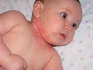Алергія на шиї у дітей і дорослих - прініни, симптоми і лікування