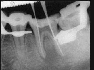 Чи можна при лікуванні зуба робити рентген кілька разів