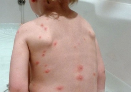 Висипання на шкірі у дитини у вигляді кропивниці і фото висипу на тілі дітей з поясненнями