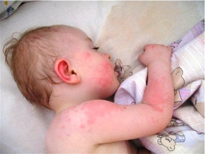 Висипання на шкірі у дитини у вигляді кропивниці і фото висипу на тілі дітей з поясненнями