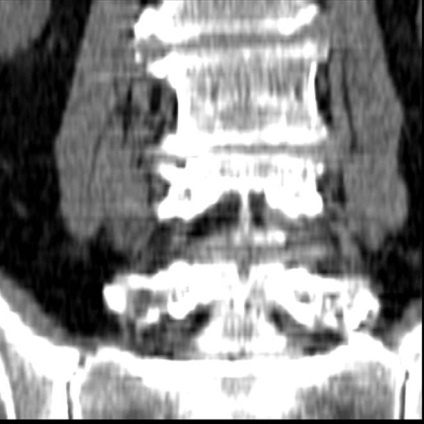 Комп'ютерна томографія в діагностиці непухлинних захворювань хребта