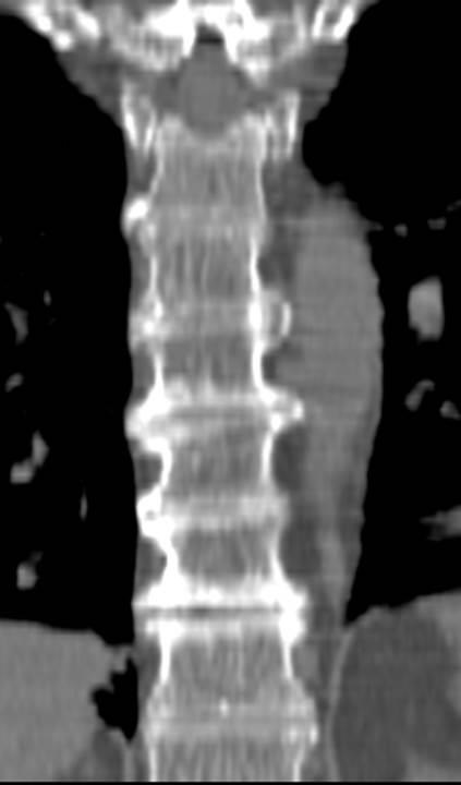 Комп'ютерна томографія в діагностиці непухлинних захворювань хребта