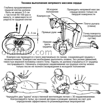 Непрямий масаж серця техніка виконання, як робити, протипоказання