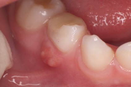 Періодонтит зуба лікування, причини, симптоми, класифікація і диференціальна діагностика