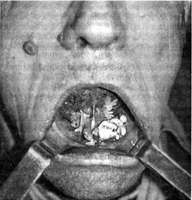 Передпухлинні захворювання слизової оболонки порожнини рота